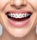Braces