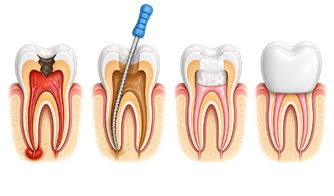  Root Canal Treatment