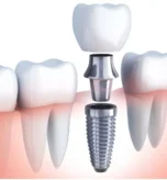What is the Cost of Dental Implants in Noida? (2026 Guide)