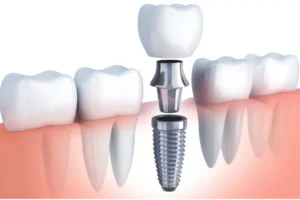 What is the Cost of Dental Implants in Noida? (2026 Guide)