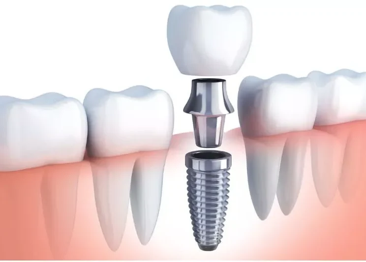 What is the Cost of Dental Implants in Noida? (2026 Guide)