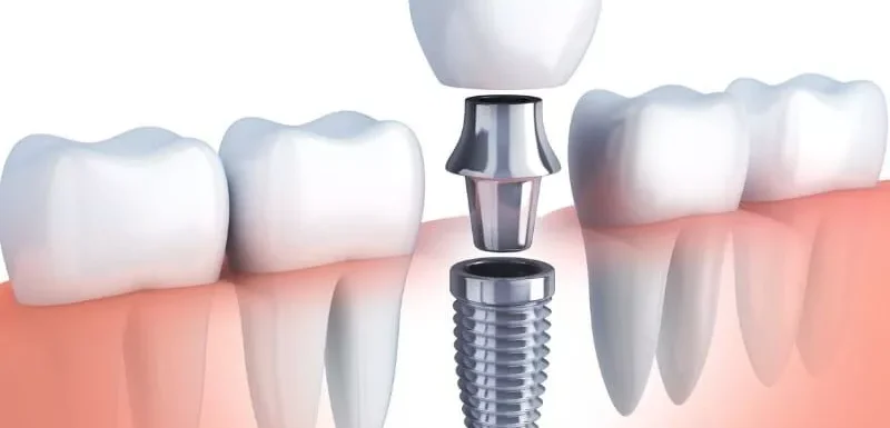 What is the Cost of Dental Implants in Noida? (2026 Guide)