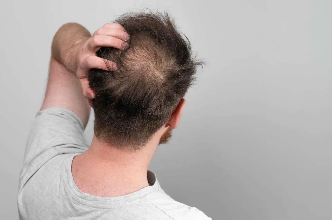 Crown-Hair-Transplant-Price-Turkey Crown-Hair-Transplant-Price-Turkey