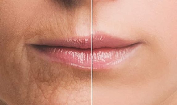 Lip-Rejuvenation-Our-Approach