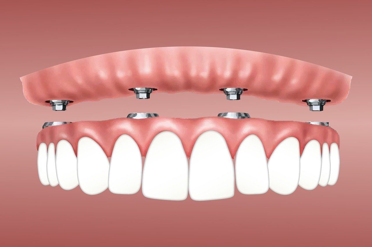 overdenture-3597628_1280