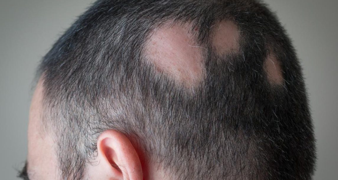 partial-alopecia partial-alopecia